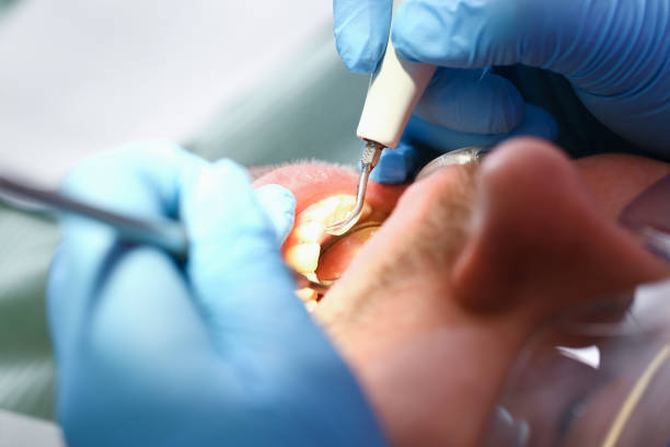 Best Emergency Wisdom Teeth Removal in Tice, FL