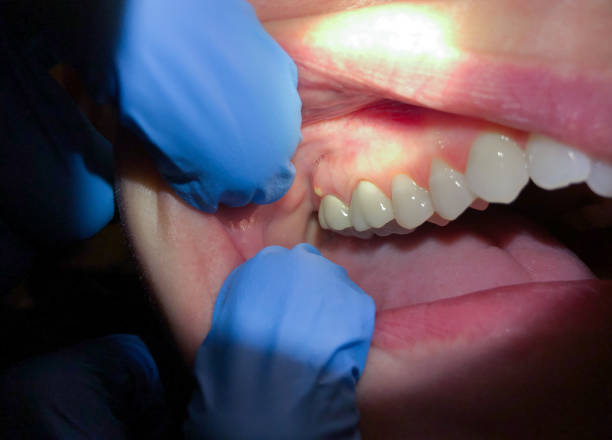 Best Emergency Wisdom Teeth Removal in Tice, FL
