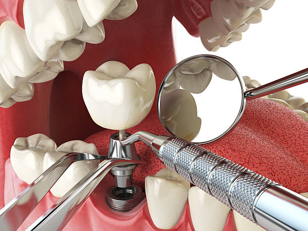 Best Emergency Root Canal Treatment in Tice, FL